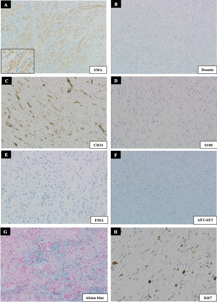 Immunohistochemistry panel of oral nodular fasciitis showing SMA positivity with negative desmin, CD34, S-100, EMA and pancytokeratin
