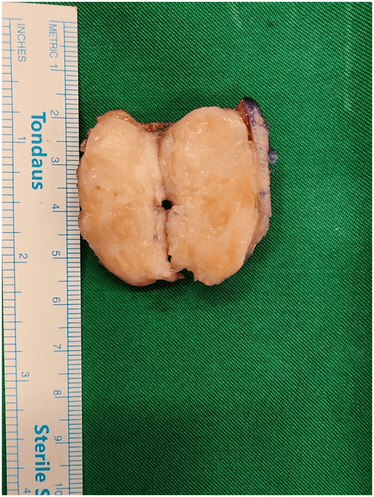 Gross specimen of a resected palmar ossifying fasciitis mass showing a smooth surface and homogeneous tan cut section