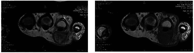 MRI of the hand showing a well-defined palmar mass with low T1 and high T2 signal surrounding the flexor tendon
