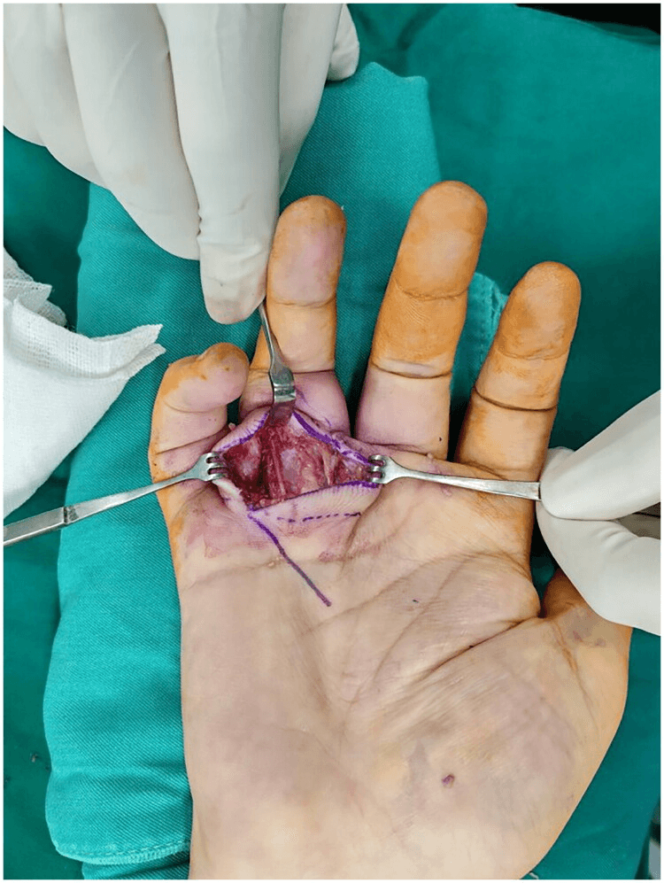 Intraoperative photograph of a palmar ossifying fasciitis mass exposed during surgical excision