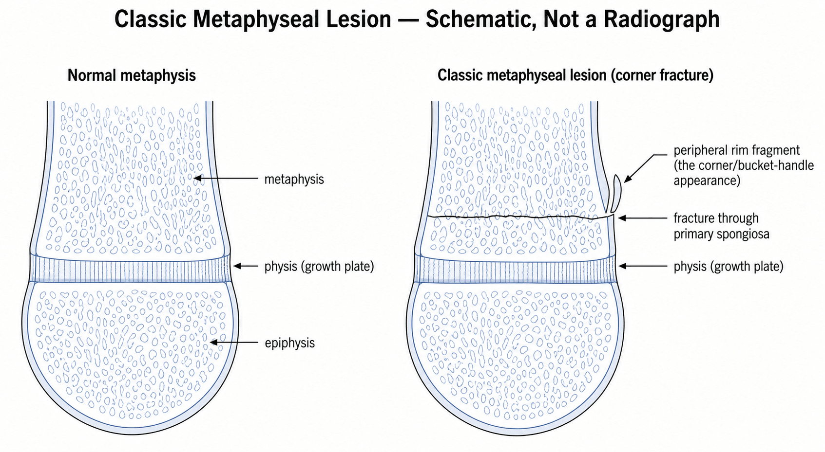Schematic diagram comparing a normal infant long-bone metaphysis with the classic metaphyseal lesion (corner/bucket-handle fracture), showing the fracture line through the primary spongiosa and the peripheral rim fragment