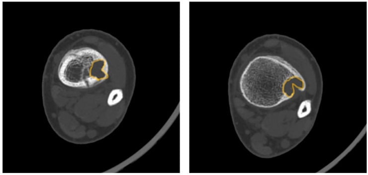 Axial CT of a distal tibial non-ossifying fibroma with a focal cortical Pac-Man sign associated with pathological fracture risk.
