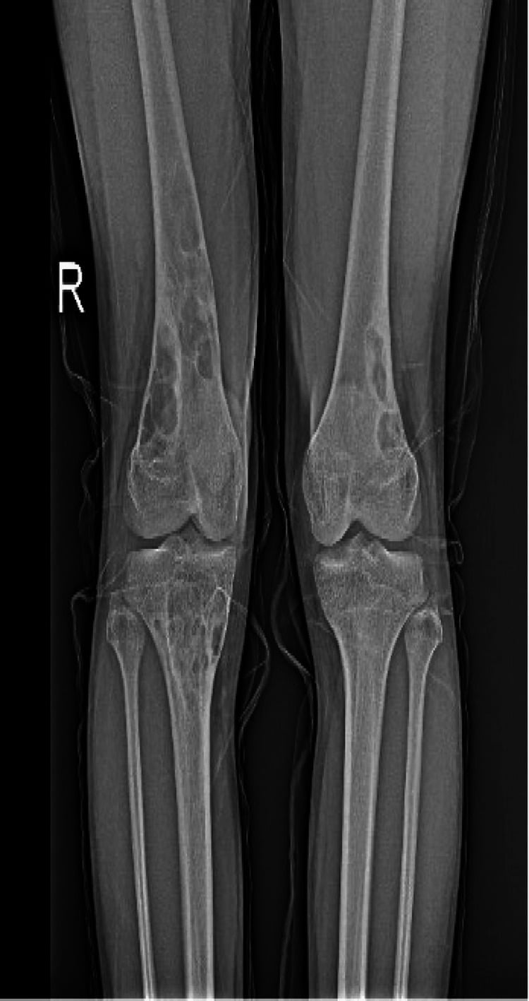 Long-leg radiographs showing multiple non-ossifying fibromas around the knees in Jaffe-Campanacci syndrome.