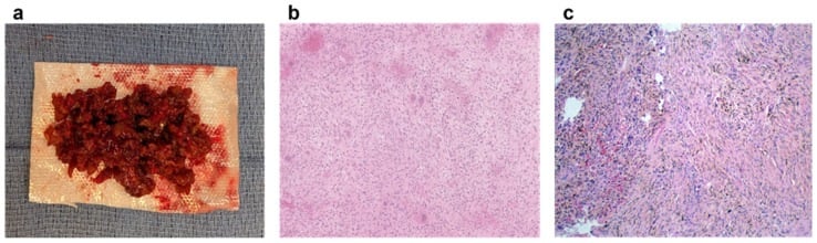 Gross and histological panels of non-ossifying fibroma showing whorled spindle-cell stroma, multinucleated giant cells and hemosiderin.