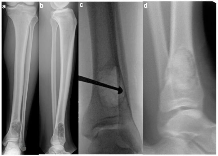 Radiographic and intraoperative sequence of a large symptomatic distal tibial non-ossifying fibroma treated by curettage and bone grafting.