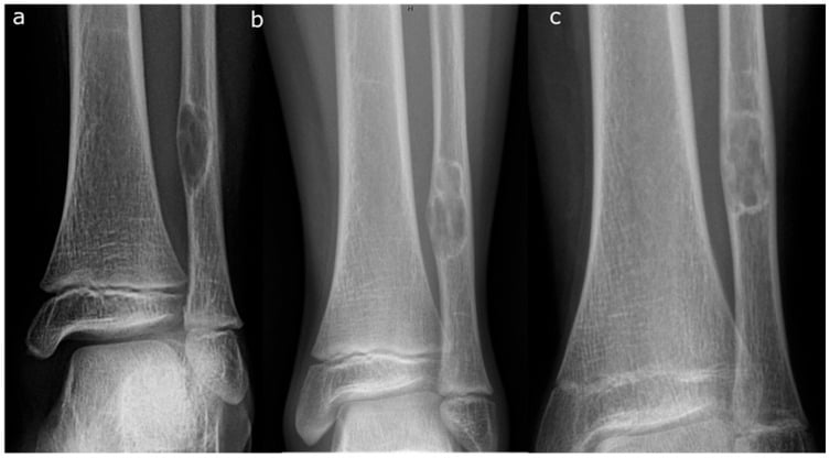 Serial radiographs showing progression of a non-ossifying fibroma from Ritschl stage A through stage B to stage C ossification.