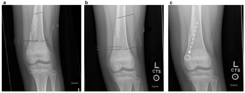 Serial radiographs showing an eccentric non-ossifying fibroma migrating away from the physis during growth.