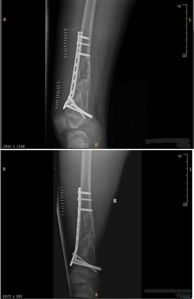 Postoperative AP and lateral radiographs of a distal femoral pathological fracture through a non-ossifying fibroma treated with plate fixation and grafted curettage.