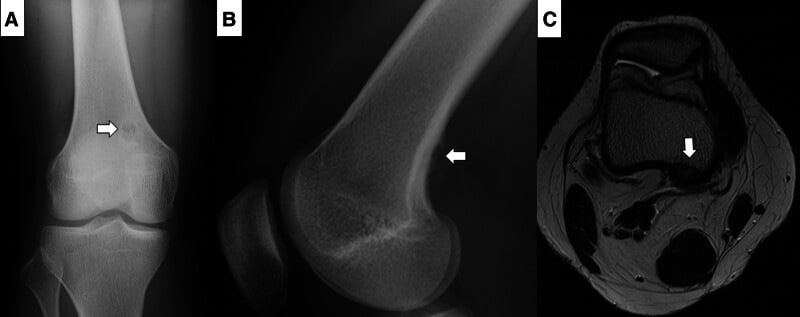 Radiographs and axial MRI of a small stage-A non-ossifying fibroma initially suspected to be osteosarcoma, showing a sclerotic margin and no soft-tissue mass.