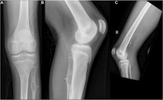 Bilateral knee radiographs showing multiple non-ossifying fibromas in both distal femora and the proximal fibula.