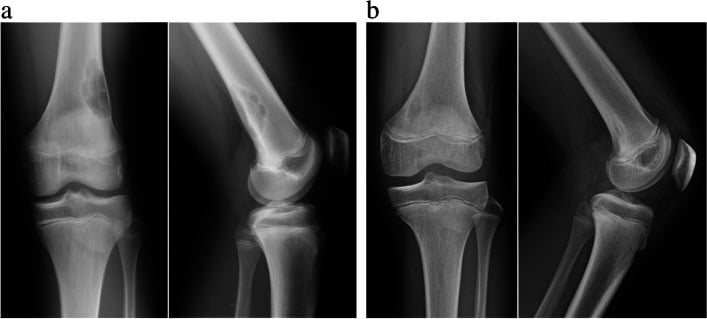 Comparison radiographs of a non-ossifying fibroma and a smaller fibrous cortical defect.