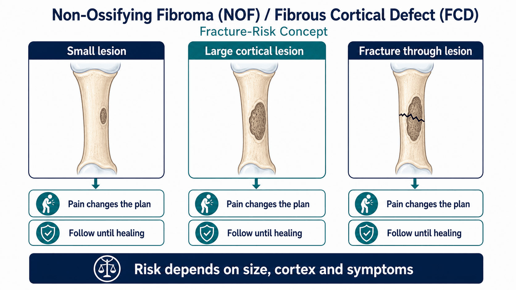 NOF and fibrous cortical defect complication concept showing small lesion, large cortical lesion and fracture through lesion