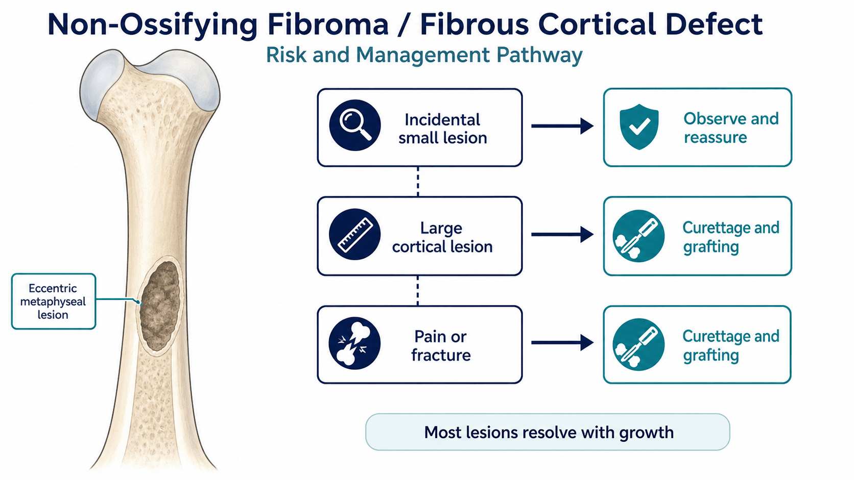 Non-ossifying fibroma management pathway showing incidental lesion, large cortical lesion, pain or fracture, observation and curettage with grafting