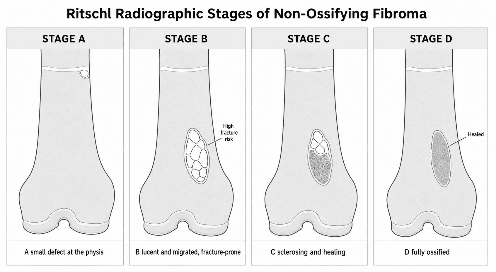 Four-panel schematic of the Ritschl radiographic stages of non-ossifying fibroma: Stage A a small juxta-physeal cortical defect, Stage B a larger multiloculated lucent fracture-prone lesion migrated into the metaphysis, Stage C a sclerosing healing lesion, and Stage D a fully ossified healed area.