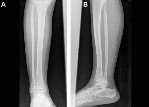 Classic distal tibia non-ossifying fibroma radiographic appearance