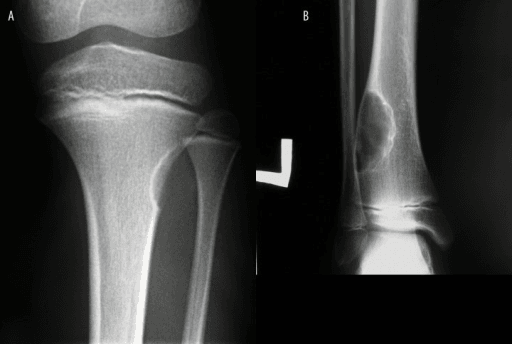 Fibrous cortical defect and non-ossifying fibroma comparison imaging