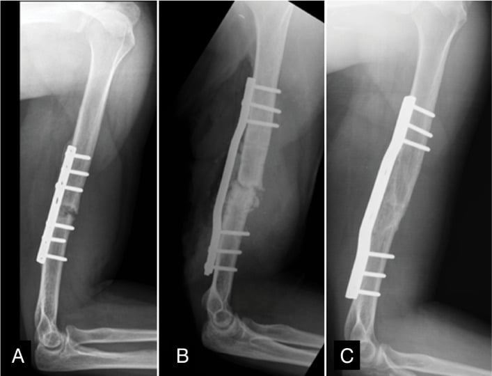Radiographs of an atrophic humeral shaft nonunion under the original plate, after revision plating with graft, and after consolidation.