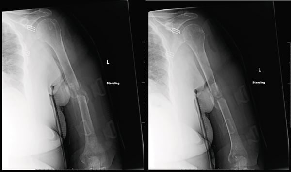 Two standing radiographs of a left humeral shaft nonunion, showing a persistent gap between the fragments and no bridging callus.