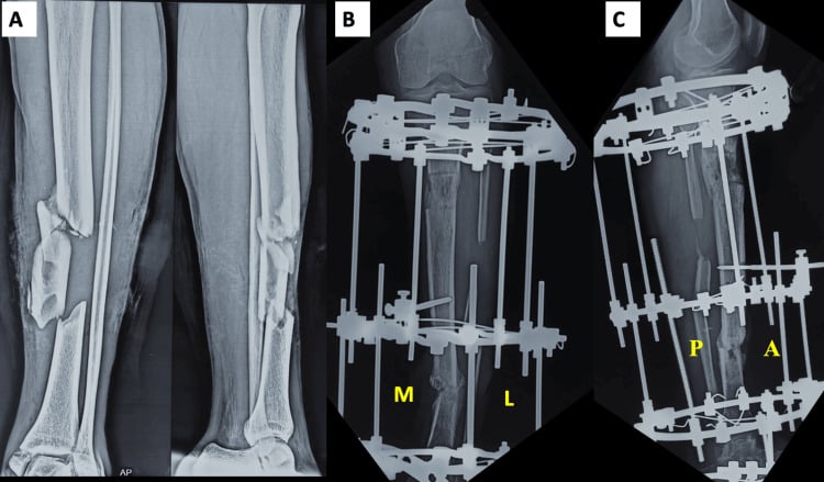 Tibial fracture radiographs before and in an Ilizarov ring frame, with the medial, lateral, posterior and anterior cortices labelled for modified RUST scoring.