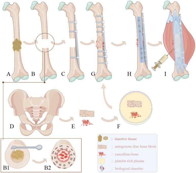 Schematic of atrophic nonunion reconstruction: excision of inactive tissue, plate fixation, iliac bone block and cancellous graft with platelet-rich plasma, and a biological chamber.