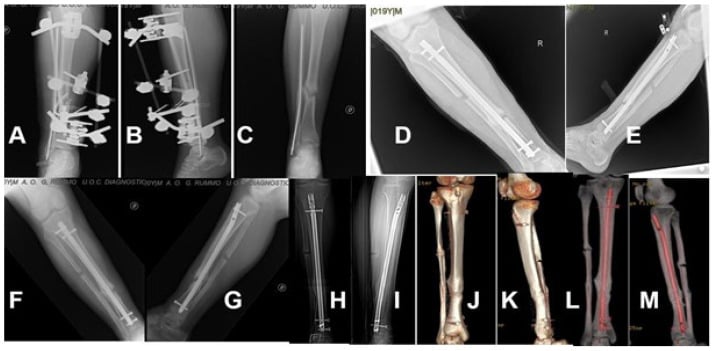 Serial radiographs and CT reconstructions (A-M) of an aseptic tibial nonunion treated first by external fixation and then by intramedullary nailing.