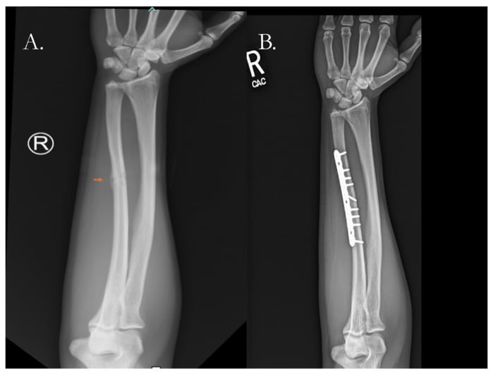 Right forearm radiographs of an ulnar shaft nonunion before (arrow at the persistent fracture line) and after plate fixation.