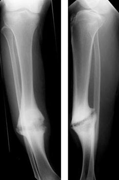 AP and lateral radiographs of a hypertrophic ('elephant foot') tibial nonunion in a 65-year-old man, showing an exuberant bulbous callus mass with a persistent lucent fracture line at its centre.