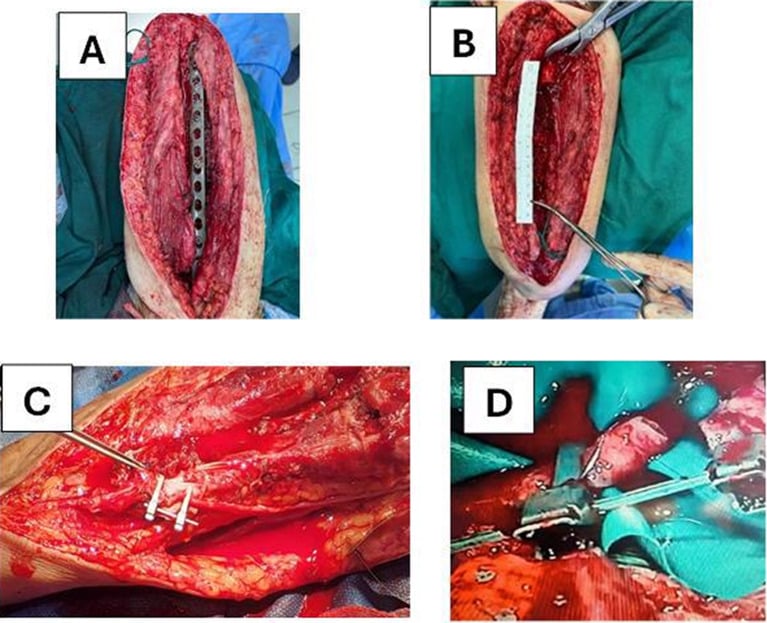 Intraoperative photographs of vascularised free-fibula reconstruction: plate at the recipient site, measurement with a paper ruler, screw fixation and microvascular anastomosis.