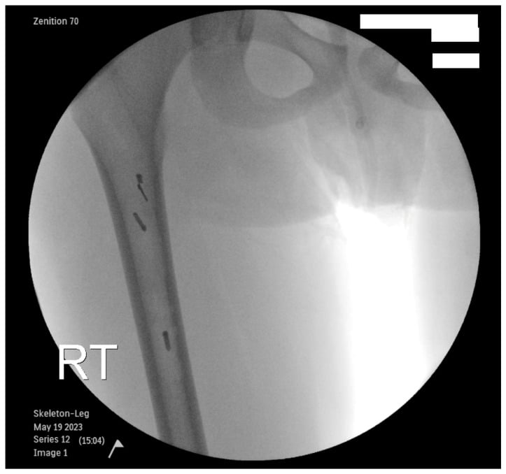 Intraoperative fluoroscopy of the right femur showing four retained RIA reamer fragments in the femoral canal.