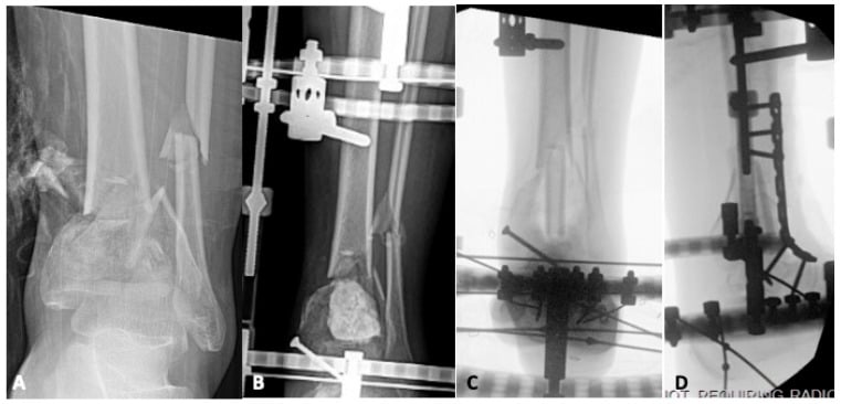 Staged treatment of an infected pilon nonunion: the comminuted distal tibial fracture, spanning external fixation with a dense block in the distal tibial defect, and circular-frame reconstruction.