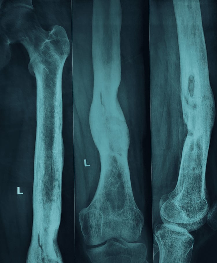 Three radiographs of a united left femur after Ilizarov treatment of an infected nonunion, with the frame removed.