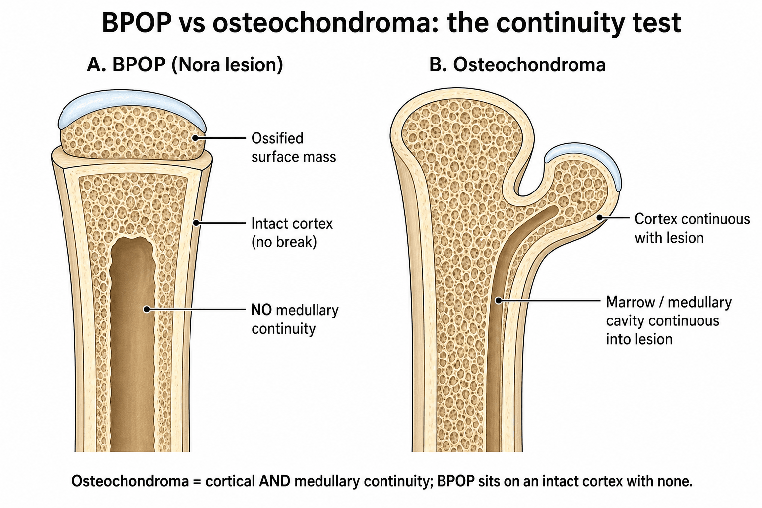 Cutaway comparison of BPOP and osteochondroma showing intact cortex and no medullary continuity in BPOP versus cortical and medullary continuity in osteochondroma