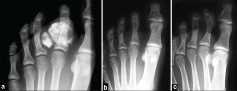 Foot radiographs showing two calcified BPOP lesions at the second-toe proximal phalanx before excision and no recurrence at four years.