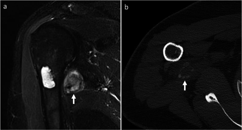 MRI and CT of myositis ossificans showing a soft-tissue mass separate from bone with peripheral zonal mineralisation.