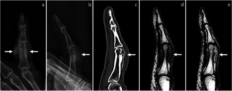 Radiograph, sagittal CT and MRI of BPOP on the little-finger proximal phalanx showing a mineralised surface mass without cortico-medullary continuity.