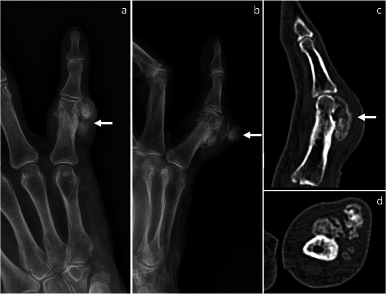 Radiographs and CT showing recurrent BPOP of the little-finger proximal phalanx with more irregular mineralisation eighteen months after excision.