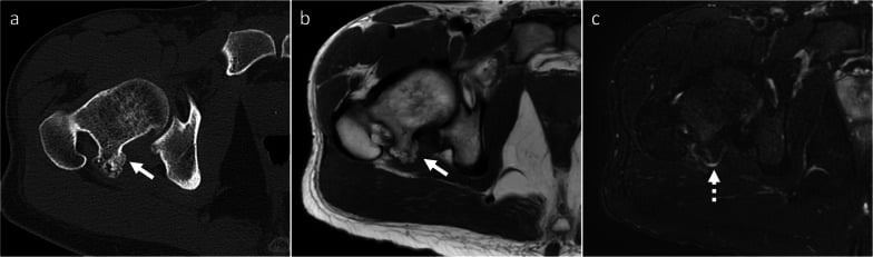 CT and MRI of osteochondroma showing cortical and medullary continuity with the parent bone and a thin cartilage cap.