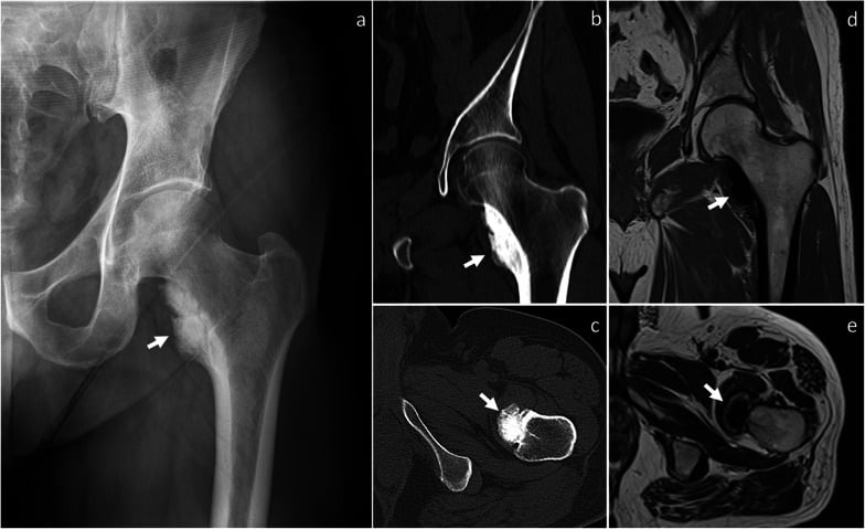 Radiograph, CT and MRI of parosteal osteosarcoma showing a heavily ossified surface mass with central dense mineralisation and cortical involvement.