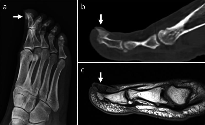 Radiograph, sagittal CT and MRI of subungual exostosis arising from the dorsal great-toe distal phalanx without marrow continuity.
