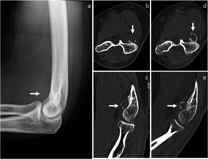 Radiograph and serial CT of florid reactive periostitis showing progressive peripheral mineralisation without cortical discontinuity.