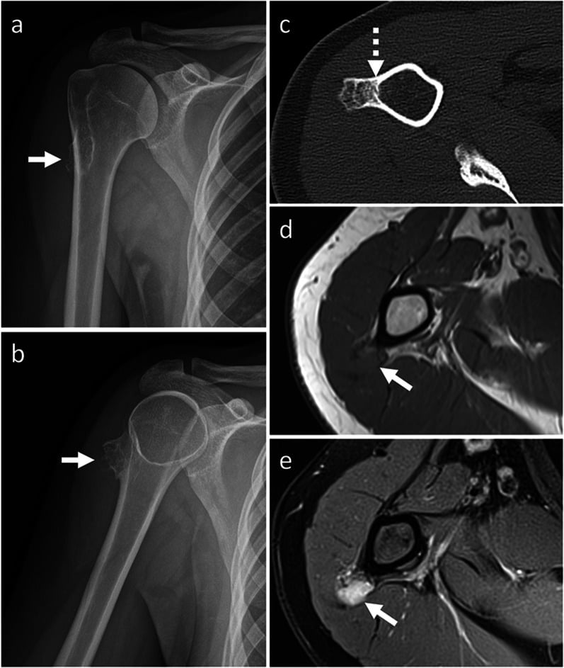Radiographs, CT and MRI of periosteal chondrosarcoma showing a mineralised surface mass with cortical remodelling and erosion.