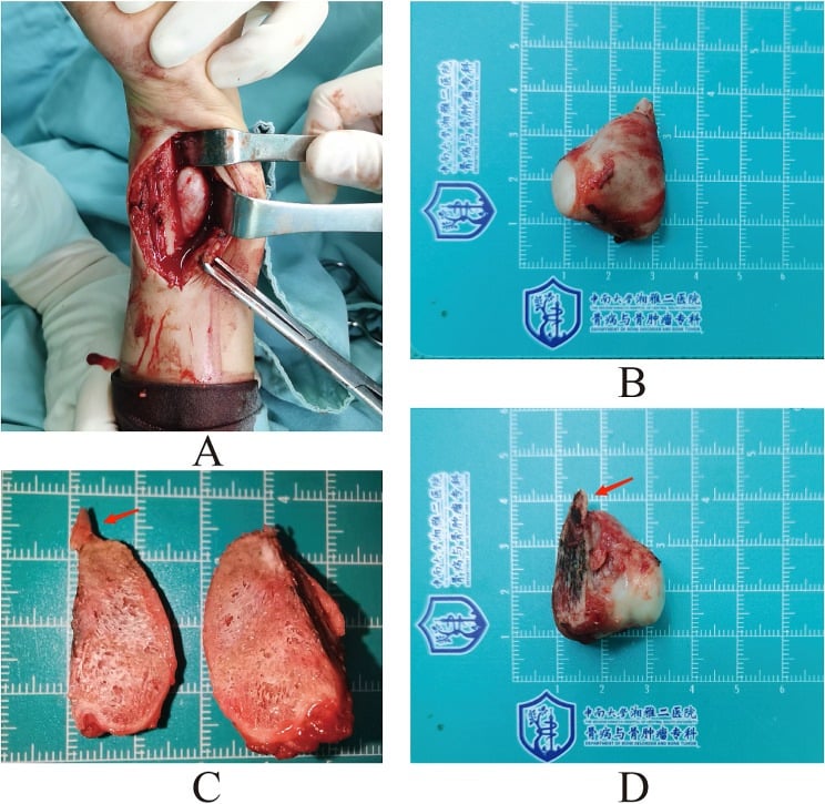 Operative exposure and excised specimen of a large BPOP at the distal ulna with a cartilage-capped surface mass.