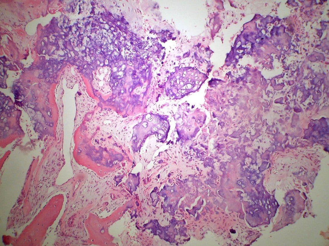 Higher-power H&E histology of a Nora lesion showing markedly hypercellular cartilage with enlarged, bizarre chondrocytes maturing into trabecular bone.