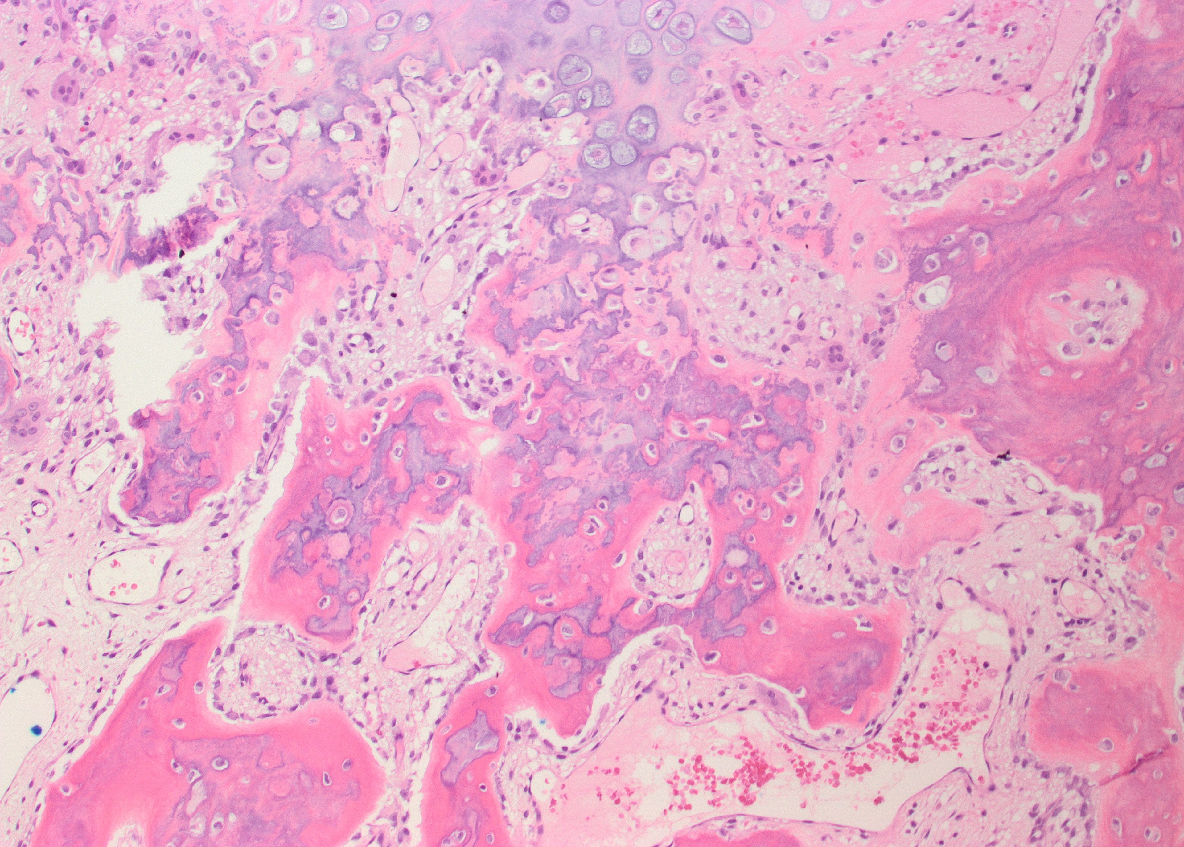 Medium-power H&E histology of a Nora lesion showing disorganised cartilage and bone with hypercellular cartilage and a basophilic blue-bone tinge.