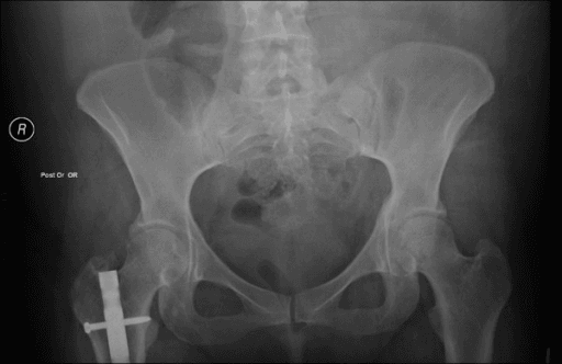 AP pelvis radiograph after surgery with fixation hardware at one hip and no residual heterotopic bone