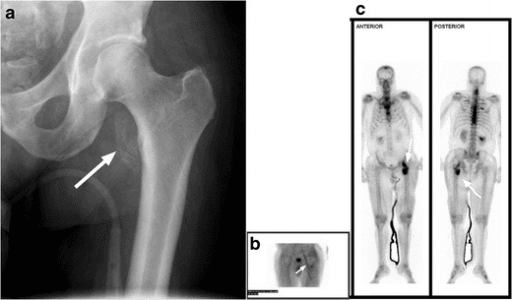 Multi-panel imaging showing early heterotopic ossification at one hip on radiograph and bone scan