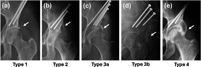 Radiographic classification of heterotopic ossification from small bony island through to bridging bone