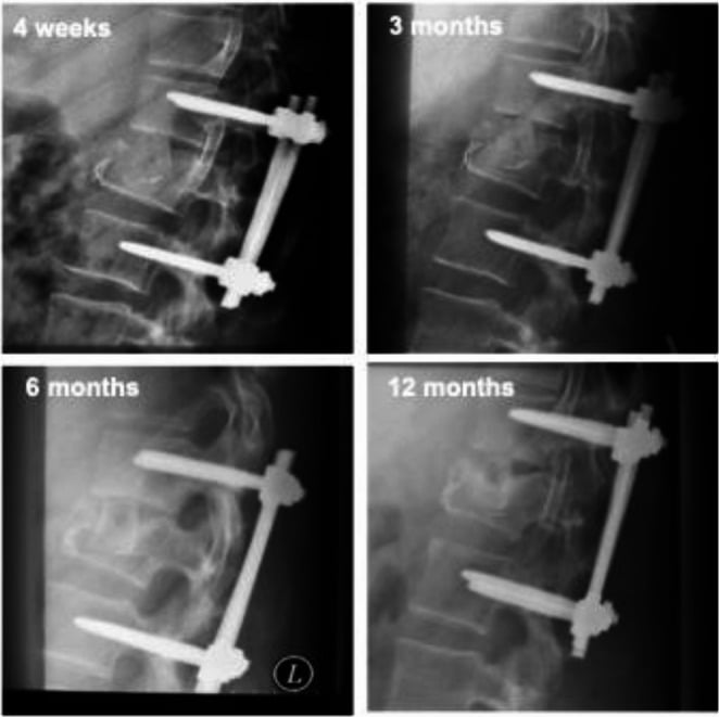 Serial radiographs documenting ongoing graft necrosis and non-fusion