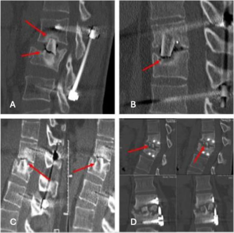 Radiographs showing different patterns of spinal non-fusion