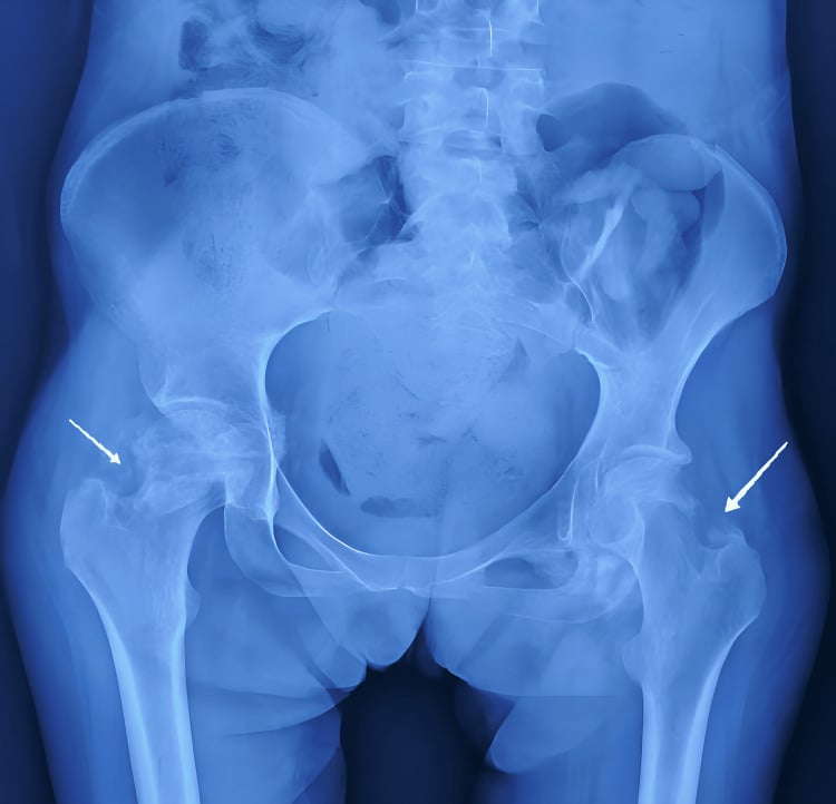 Anteroposterior pelvic radiograph showing bilateral cloudy periarticular ossification